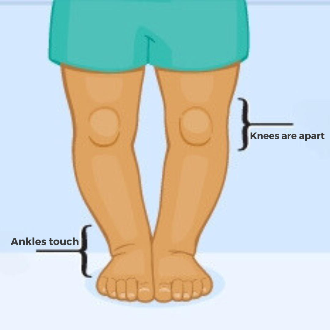 Bow Legs in Children